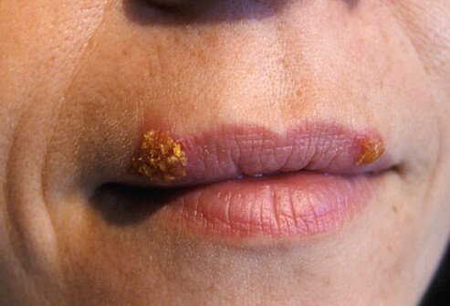 Cold sores