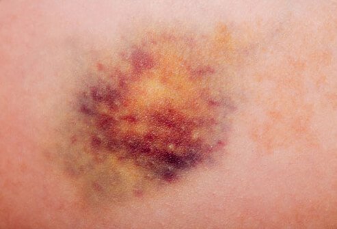 If you fall, bump into something, or get hit, you may get a bruise.