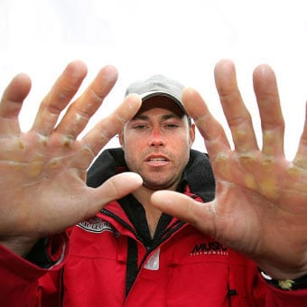 A man has severe calluses on his hands.