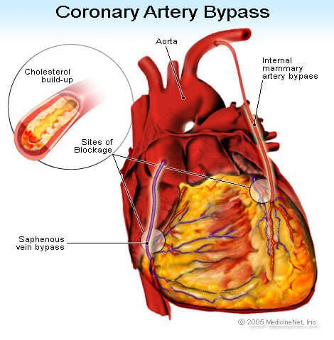 Coronary Artery Bypass illustration