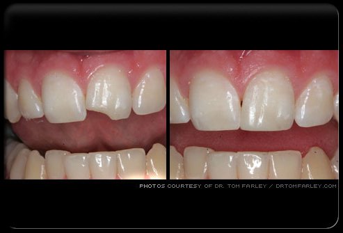 Picture of Dental Bonding
