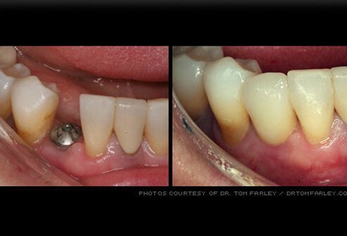 Dental implants are replacement tooth roots made of titanium.