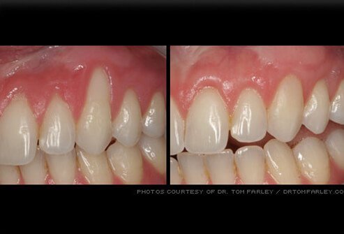Gum recession can expose tooth roots.