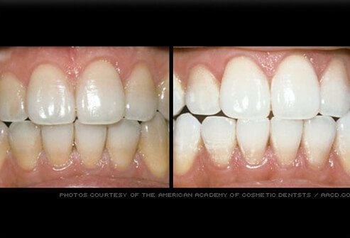 A variety of professional treatments as well as over-the-counter products are available for tooth whitening.