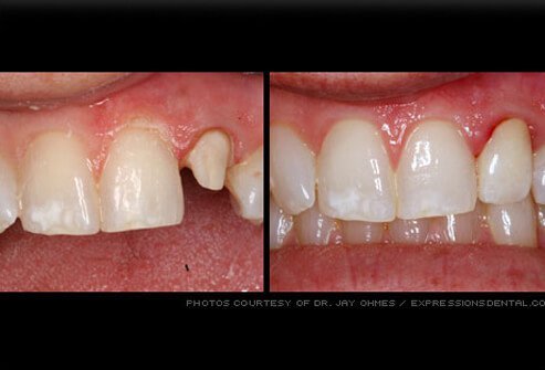 Dental Crown Procedure