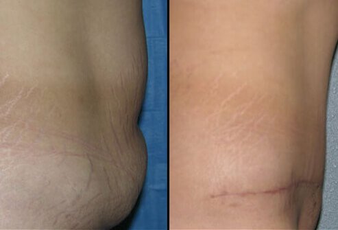 Belly fat and belly protrusion can be reduced by a tummy tuck.