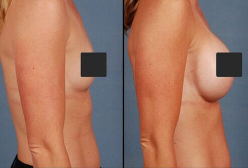 Breast implant surgery (termed augmentation mammoplasty) is a common cosmetic surgical procedure for women.