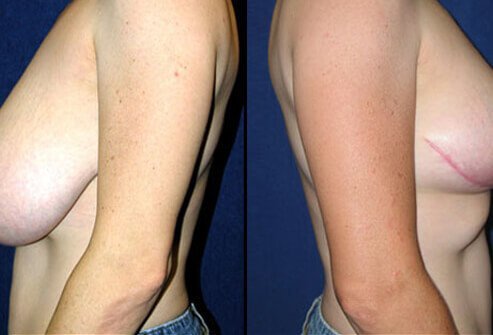Some women develop large heavy breasts that can cause neck and back pains.