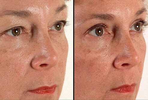 Blepharoplasty (eyelid surgery) can improve droopy upper eyelids and baggy skin under the eyes.