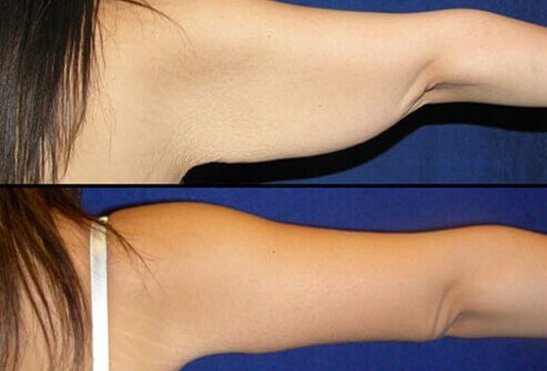 Brachioplasty or an arm lift can reduce the flappy or saggy skin and fat that women especially develop near the triceps and upper arm with age.