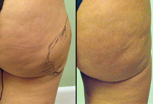 Photos of before and after liposuction.