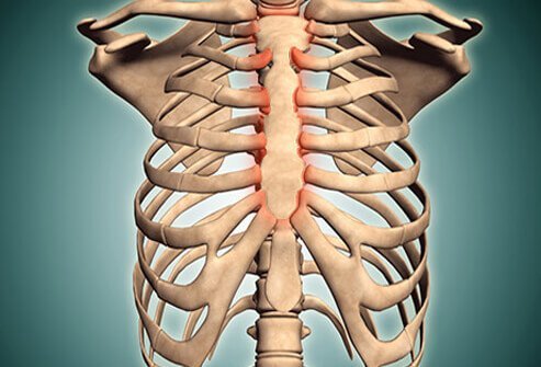 Costochondritis