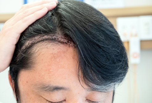 A craniotomy, or surgical hole in the skull, may be necessary on its own to relieve pressure, but also as a means to access the brain for various other procedures.