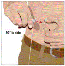 Inserting and securing the subcutaneous needle set - Illustration