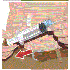 Inserting and securing the subcutaneous needle set - Illustration