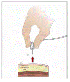 Remove subcutaneous needle  - Illustration