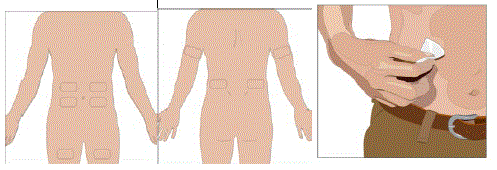 Prepare the infusion site - Illustration