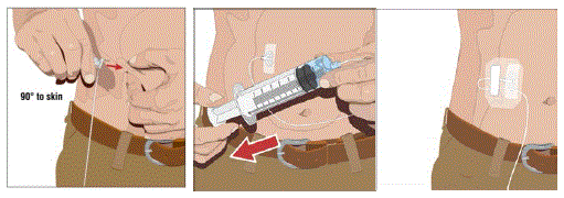 Insert and secure the subcutaneous needle set - Illustration