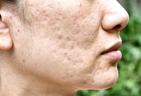 Severe acne causes breakouts that often extend deep into the skin. In severe acne, a single pimple or cyst can stay on the skin for weeks or months at a time. Grade III acne is considered severe acne.