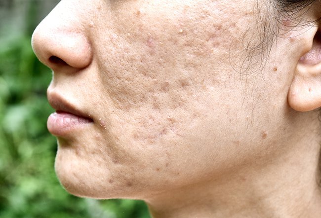 Acne Scars