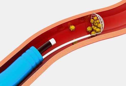 It may look like cystoscopy will be painful, but it does not usually cause distressing levels of pain.