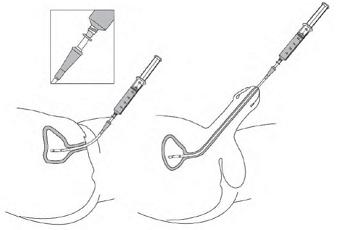 Insert the tapered end of the catheter adapter into the funnel opening of the catheter - Illustration