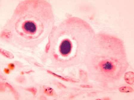 Picture of owl eye inclusion bodies in kidney cells of an individual with cytomegalovirus infection