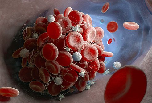Depending on the location of the thrombus or blood clot, thrombosis may include pain and warmth in the area of the clot, or chest pain and difficulty breathing if the clot is near the lungs, among other symptoms.