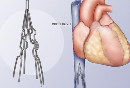 This filter catches breakaway clots and stops them from getting into your lungs and heart.