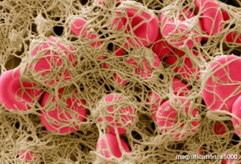 Anything that damages the inner lining of a vein may cause DVT.