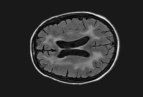 A 40-year-old woman diagnosed with HIV presented with confusion and decline in memory. The MRI shows atrophy and white matter hyperintensity on T2 not involving U-fibers.