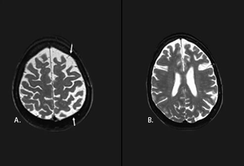 Picture of Corticobasal degeneration (CBD)