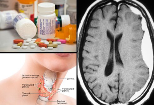 An assortment of medications (top left), MRI of subacute subdural hematoma (right) and illustration of the thyroid (bottom left).