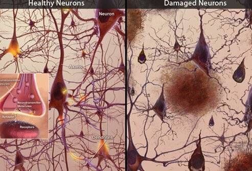 This illustration shows healthy brain neurons (left) and damaged brain neurons (right) caused by AD: plaques, tangles, and the loss of connection between neurons.