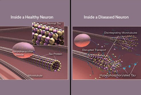 These illustrations compare healthy (left) and diseased neurons (right).