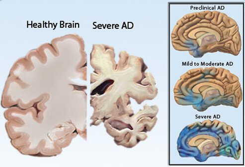 Illustrations showing a healthy brain vs. a brain with severe Alzheimer's disease (left) and the progression of AD from preclinical to moderate to severe (right).