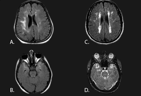 One type of vascular dementia called multi-infarct dementia (MID) is caused by multiple small strokes in different areas of the brain.