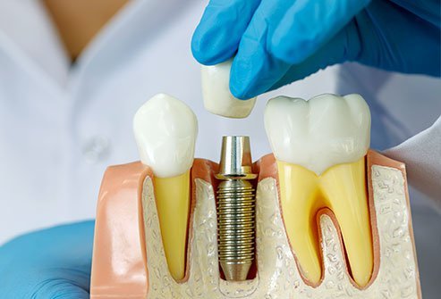  Dental Implants Procedure