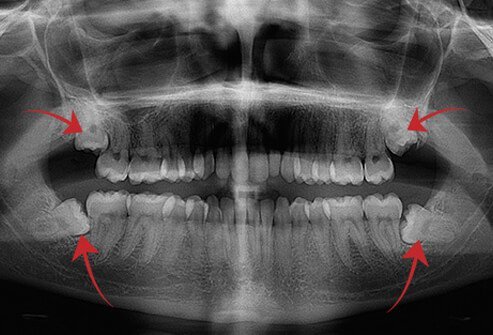 X-ray of disease free impacted wisdom teeth.