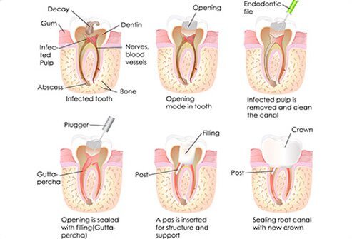 Step by step illustration of a root canal procedure.