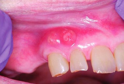 Periodontal abscesses involving 2 neighboring teeth.
