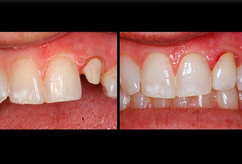 Before and after picture of a damaged tooth that was improved with a crown.
