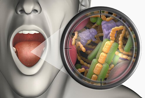 Illustration of open mouth with a magnified zoom out of bacteria that lead to bad breath (halitosis).