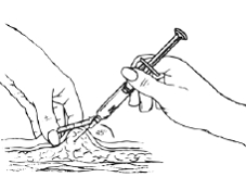 Gently grasp and squeeze a large area of skin in the chosen injection area - Illustration