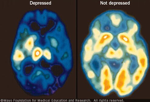 While everyone feels sad from time to time, if that occurs most days for more than two weeks, it could mean that clinical depression is occurring.