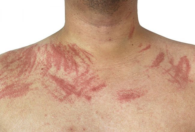 The exact cause of dermatographia is unknown.