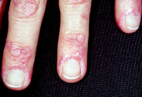 Myositis means swelling and redness of the muscles.