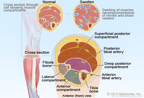 Compartment Syndrome Illustration