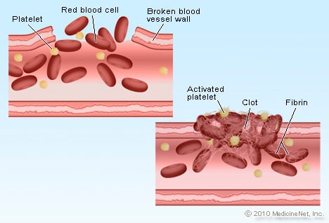 Picture of Blood Clot