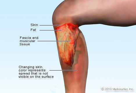 Picture of Necrotizing Fasciitis